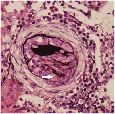 Analysis of 14 Patients With Congenital Nephrotic Syndrome